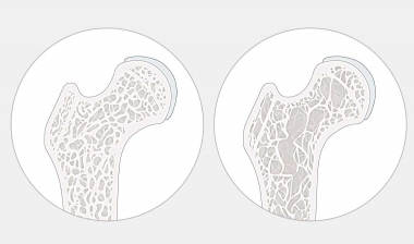 Gesunder Knochen (links), Osteoporose (rechts)
